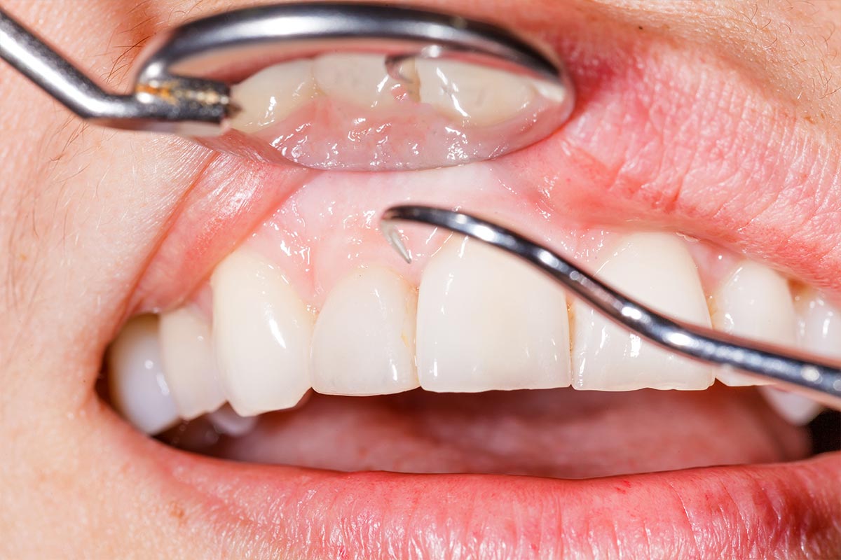 Treating Gum Disease