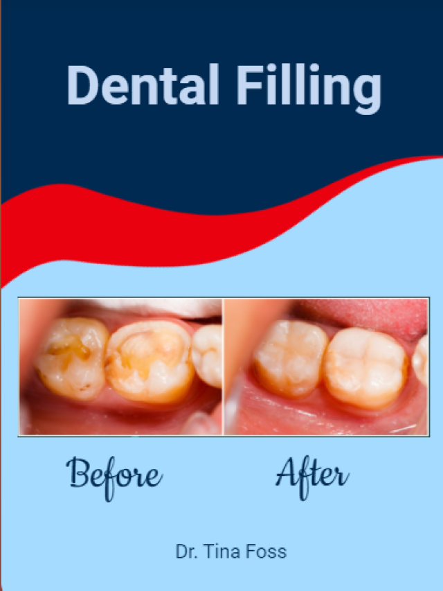 Dental Filling