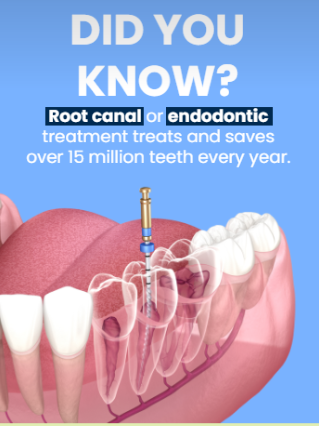 Did you know? Root canal or endodontic treatment